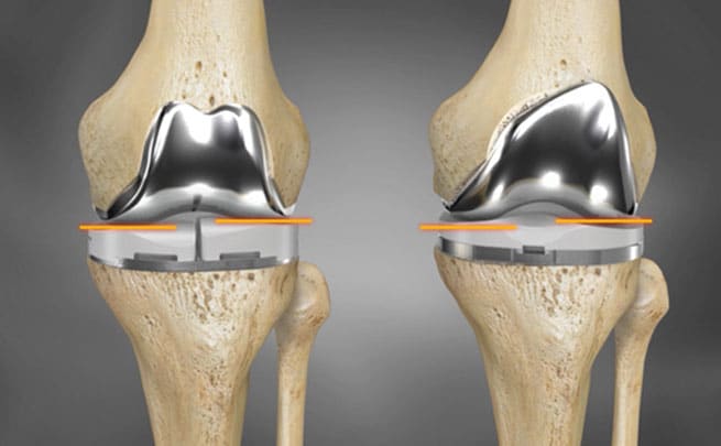 Replacement of Joints