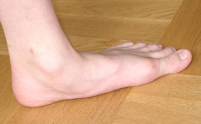 hands-foot-ankle-surgery-chennai